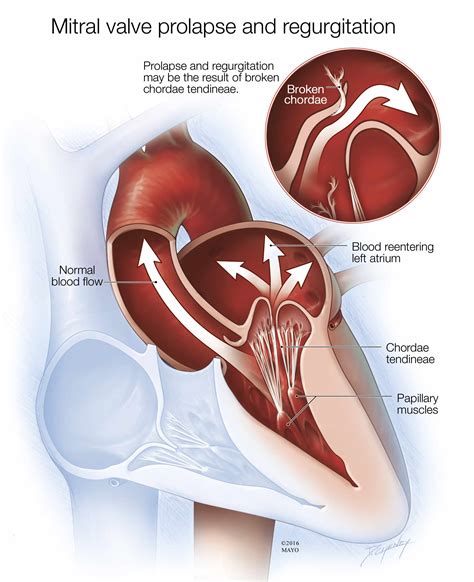 Mayo Clinic Q and A: Vast Majority of People With Mitral Valve Prolapse ...
