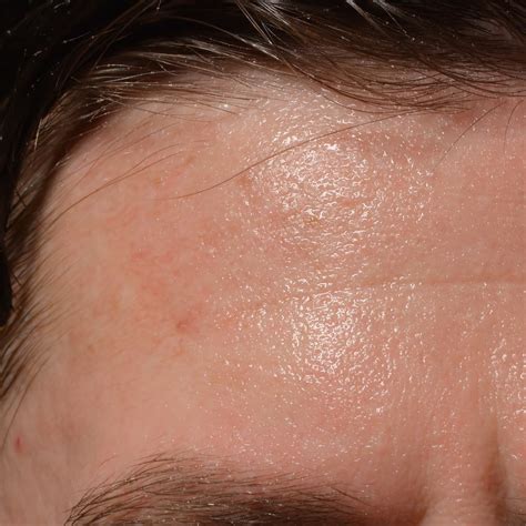 why do i sweat so much from my face 16