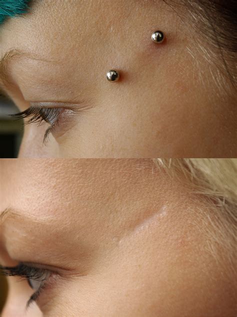 Dermal Piercing: Pictures, Procedure, Aftercare, and Risks - HubPages