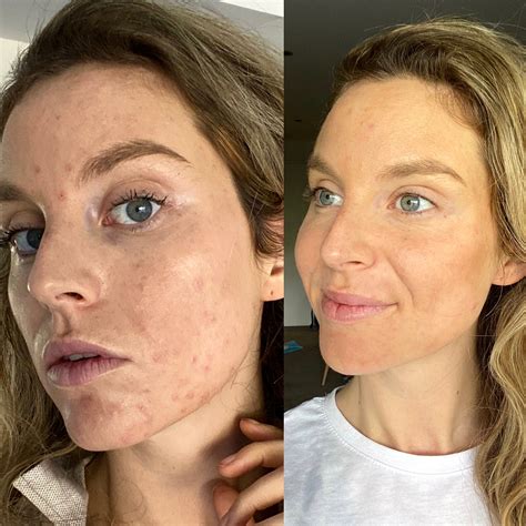 How I Healed My PCOS Acne Naturally - PCOS To Wellness