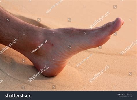 Foot Visible Bites Chigoe Flea Sahara Stock Photo 1273497514 | Shutterstock