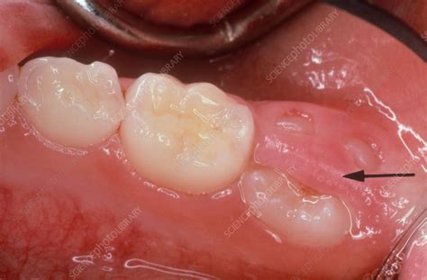 erupting molar stock image  science photo library