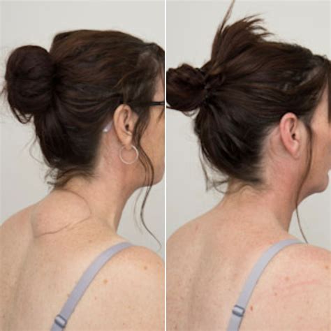 lipoma removal gmc cosmedical clinics sydney