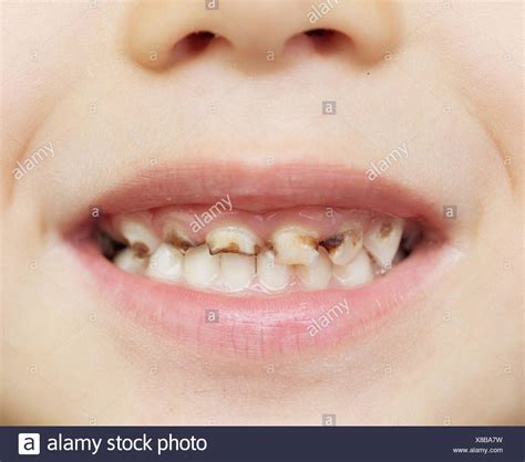 bad teeth high resolution stock photography  images alamy
