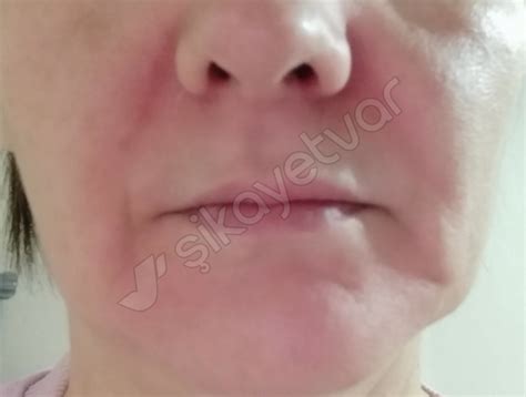 Estee Lauder (US) Estée Lauder Product Caused Severe Skin Reaction - Xolvie