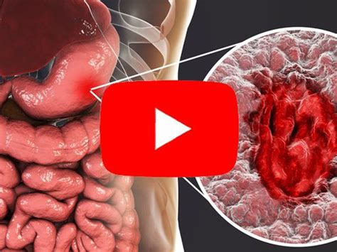 O Que É Pangastrite Enantematosa Moderada - A Pangastrite Pode Causar Hemorragia Gástrica? - Prof Dr. Luiz Carneiro