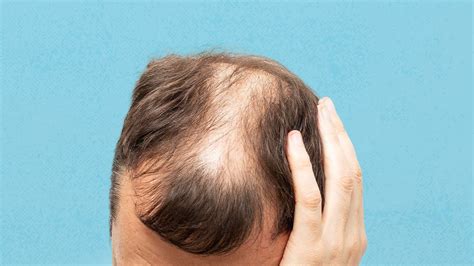 types  baldness