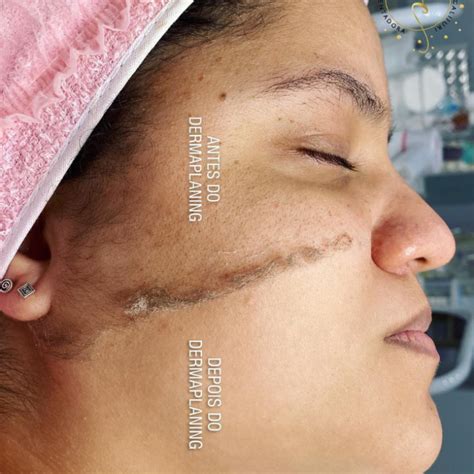 Dermaplaning Para Que Serve - Para que serve o Dermaplaning? Especialista explica tudo