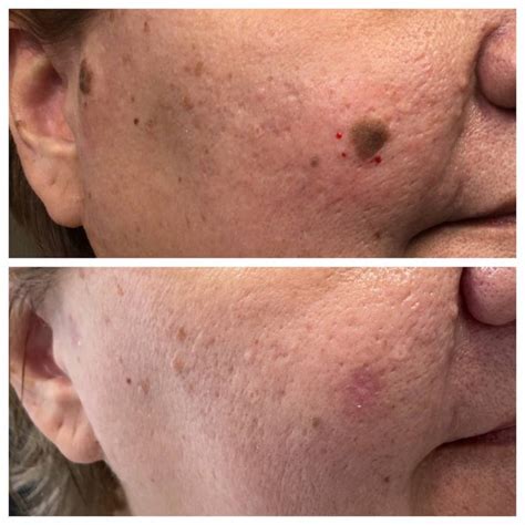 Seborrheic Keratosis Removal Before and After St. Louis Dermatology ...