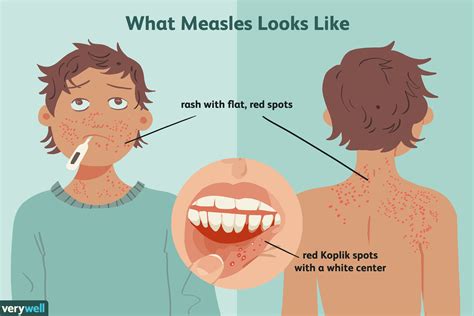 measles prevention