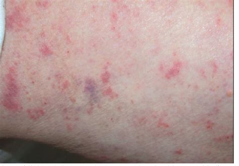 Figure 1 from Violent Purple-Red Thigh Rash in an Aged Woman | Semantic ...