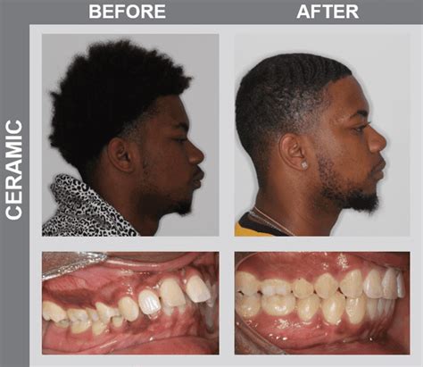 smile gallery   afters ncoso orthodontics