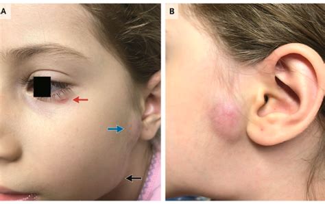parinaud oculoglandular syndrome   treatment obn