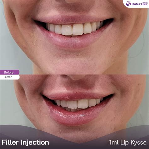 Lip Fillers Before and After Photos - Siam Clinic Thailand