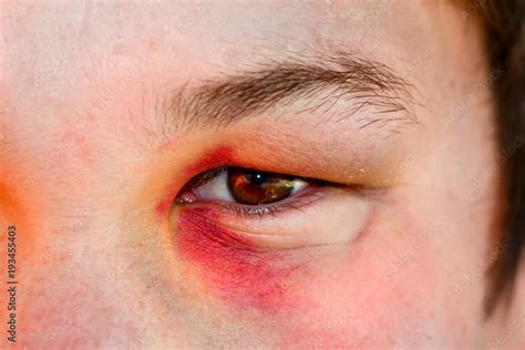 Eye injury, male with black eye isolated on white. man after accident or fight . Stock Photo ...