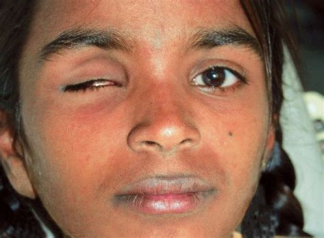 missing eye emergency eye care  brunswick dr brown