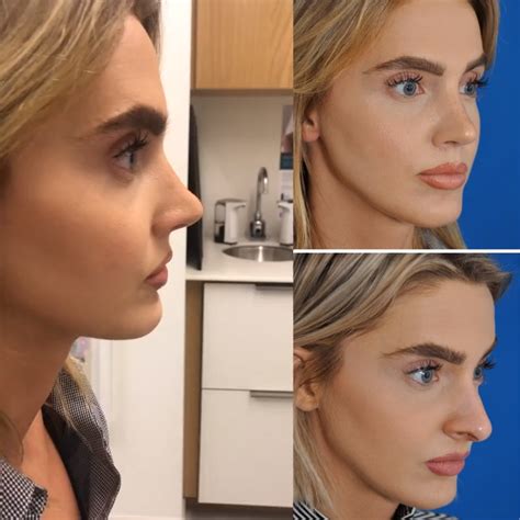 8 things to know before getting rhinoplasty – Artofit