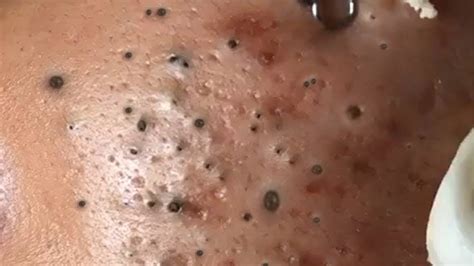 Unbelievable Blackhead Removal 2024: The Ultimate Guide to Poreless Skin - tmown2l