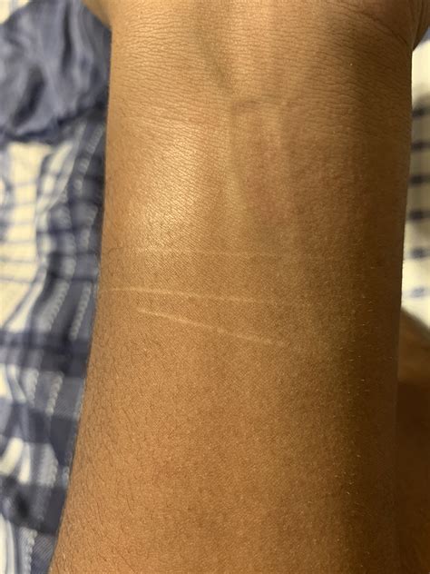 Can anyone tell me what type of scar this is and what I could to to