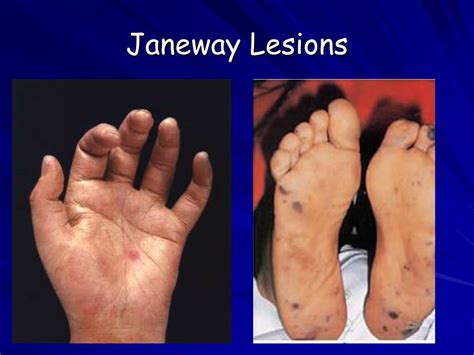 PPT - Infective Endocarditis PowerPoint Presentation, free download ...