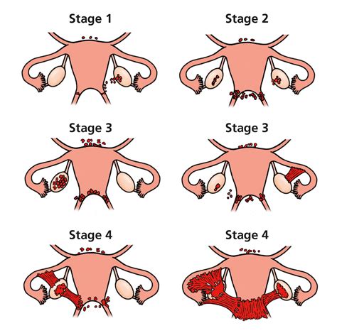 endometriosis leeds teaching hospitals nhs trust