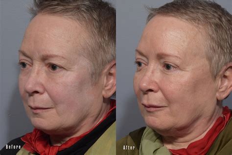 Eyelid Surgery, Patient 12 • Pearlman Aesthetic Surgery
