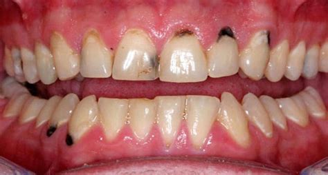 How to remove black spots on teeth | Vinmec