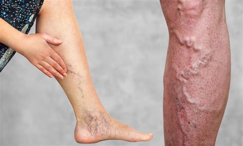 Medfin BlogVaricose Veins vs Spider Veins: What’s the Difference