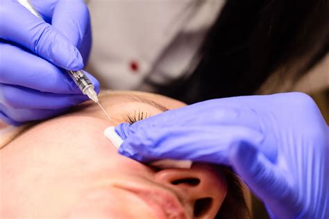 Milia Removal the Right Way with Our Milia Extraction Facial