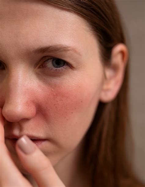 laser  redness  singapore  dr lee hwee chyen