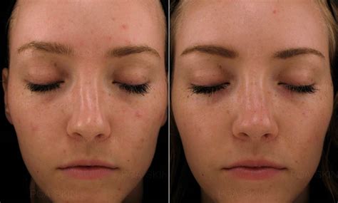Миндальный пилинг Perfecting Peel в Киеве