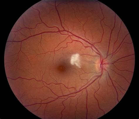 cotton wool spots disease entity  management