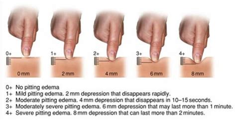 Edema Nursing School Tips, Nursing Study, Nursing Tips, Nursing Notes ...