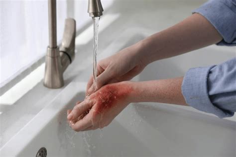 4,890 Cool Water For Burn Royalty-Free Photos and Stock Images ...