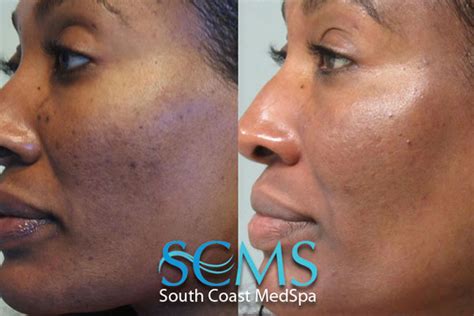 Acne Scar Removal - South Coast Med Spa