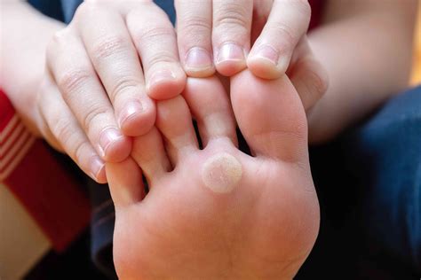 Bump on Toe: Causes and Treatments