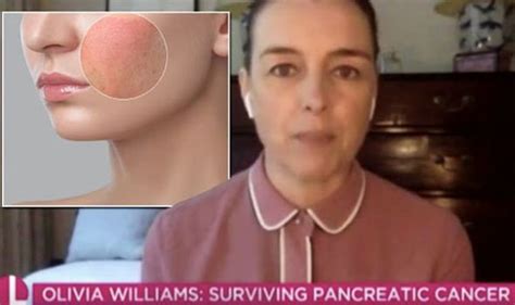 pancreatic cancer symptoms survivor olivia williams shares bizarre