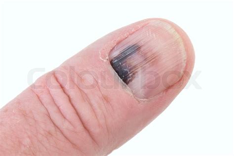 Bruised finger nail | Stock image | Colourbox