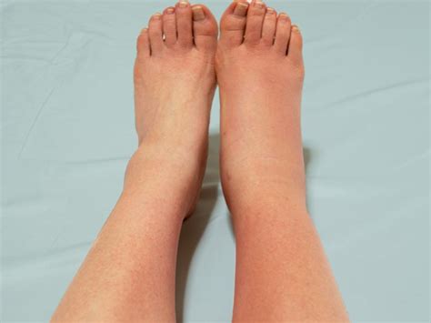 cellulitis   worry symptoms   ignore