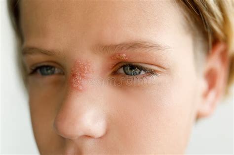 Large Red Rash on the Nose and Over the Child S Eye - Dermatolonia ...