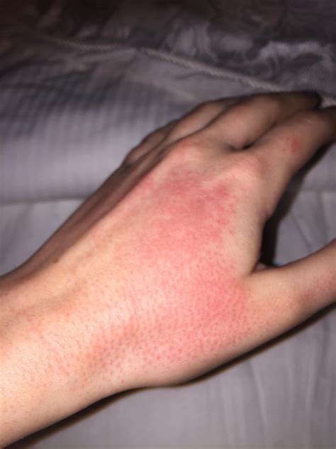 HELP! Rash on hands from Accutane? - Prescription acne medications