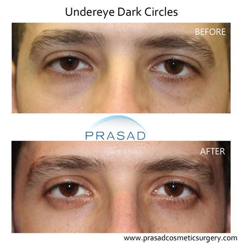 platelet rich plasma injection manhattan nyc  long island