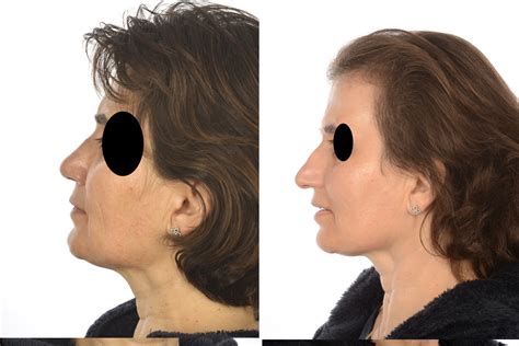 rhinoplasty lhcsc