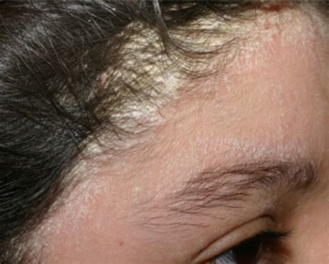 seborrheic dermatitis face