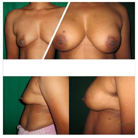 Breast Augmentation India, Breast Implants Thrissur, Breast Procedures ...