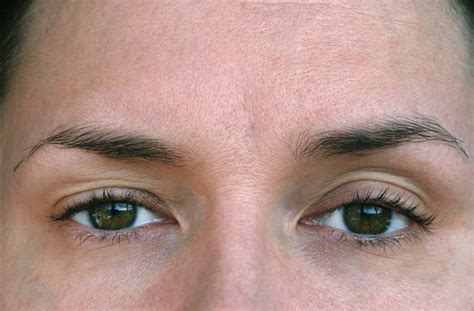 What is Ptosis? | David Ghozland