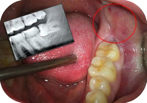 Зуб мудрости растет и болит десна: что делать, как снять боль | Dental Art