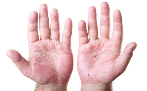 Hand Dermatitis: Causes, Prevention & Treatments – SkinKraft