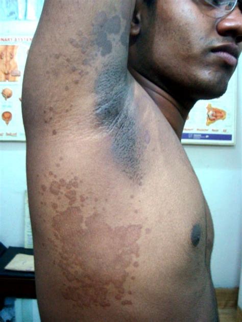 Global Skin Atlas | Diagnosis Detail