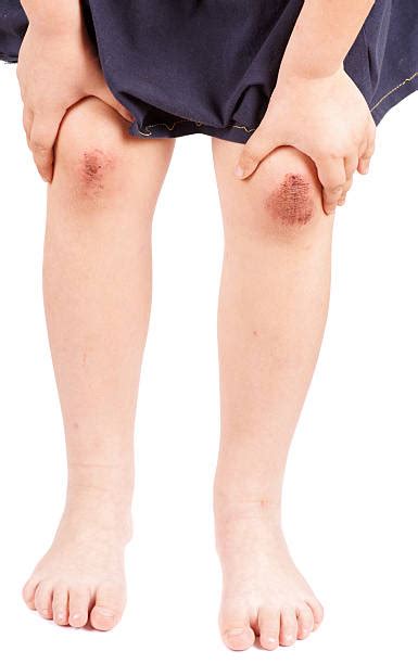Scraped Knee Stock Photos, Pictures & Royalty-Free Images - iStock